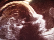 Ultraschallbild: Dat Kind hett Köpfchen!